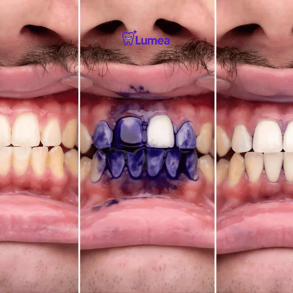 Lumea™ Serum Cromático V34 | El Abrillantador Dental Nº1