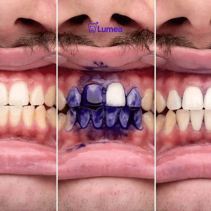 Lumea™ Serum Cromático V34 | El Abrillantador Dental Nº1