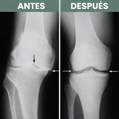 Detenga el dolor, la hinchazón y la rigidez de la rodilla en pocos días o le devolvemos su dinero
