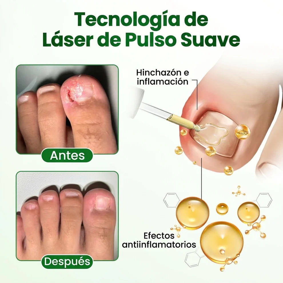 7Days™ Tratamiento Anti Hongos - Elimina Uñas Amarillas y las Fortalece desde 7 Días