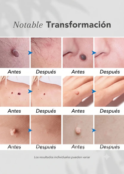 Lápiz para eliminar angiomas 6 en 1