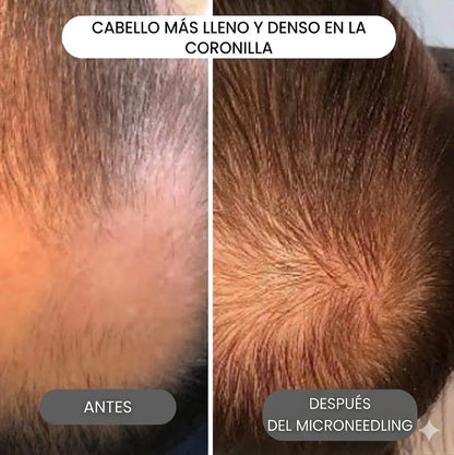 El sistema de infusión de péptidos más potente para el crecimiento del cabello